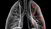 声音嘶哑或是肺癌症状 预防肺癌要远离高脂肪