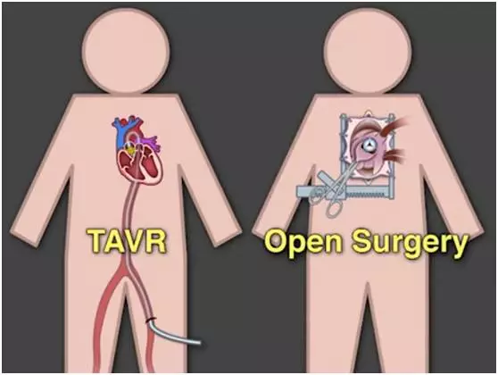 心脏瓣膜植入/修复手术