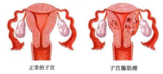 泰国试管婴儿之子宫肌瘤的常识